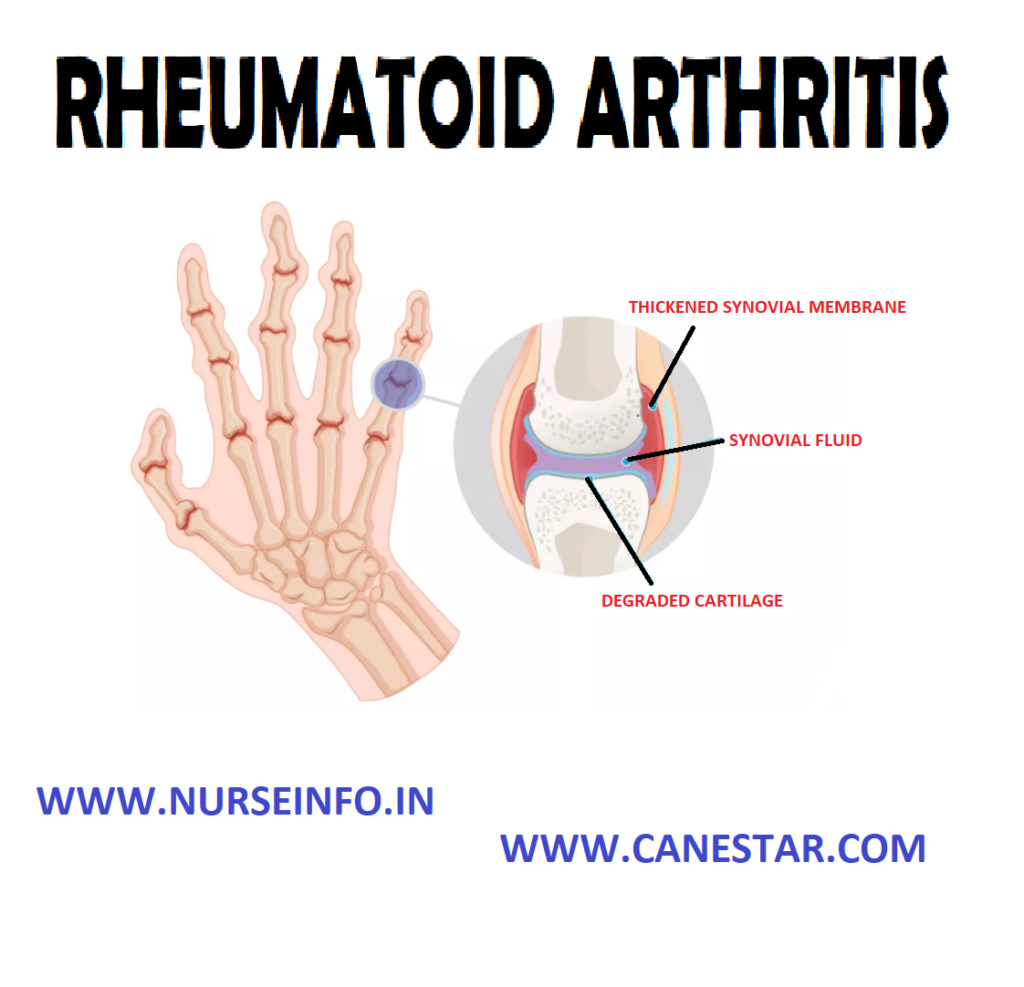 RHEUMATOID ARTHRITIS – Etiology and Risk Factors, Pathophysiology, Clinical Manifestations, Diagnostic Evaluations and Management