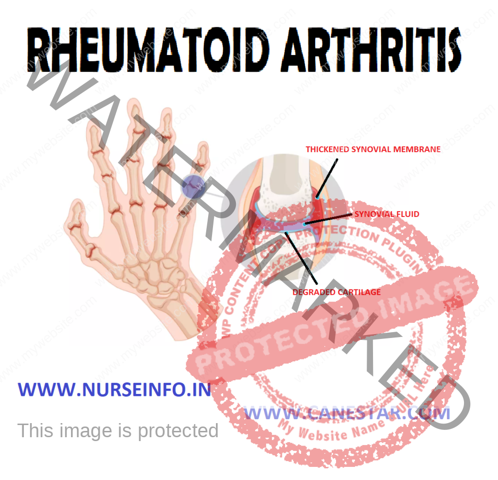 RHEUMATOID ARTHRITIS – Etiology and Risk Factors, Pathophysiology, Clinical Manifestations, Diagnostic Evaluations and Management 