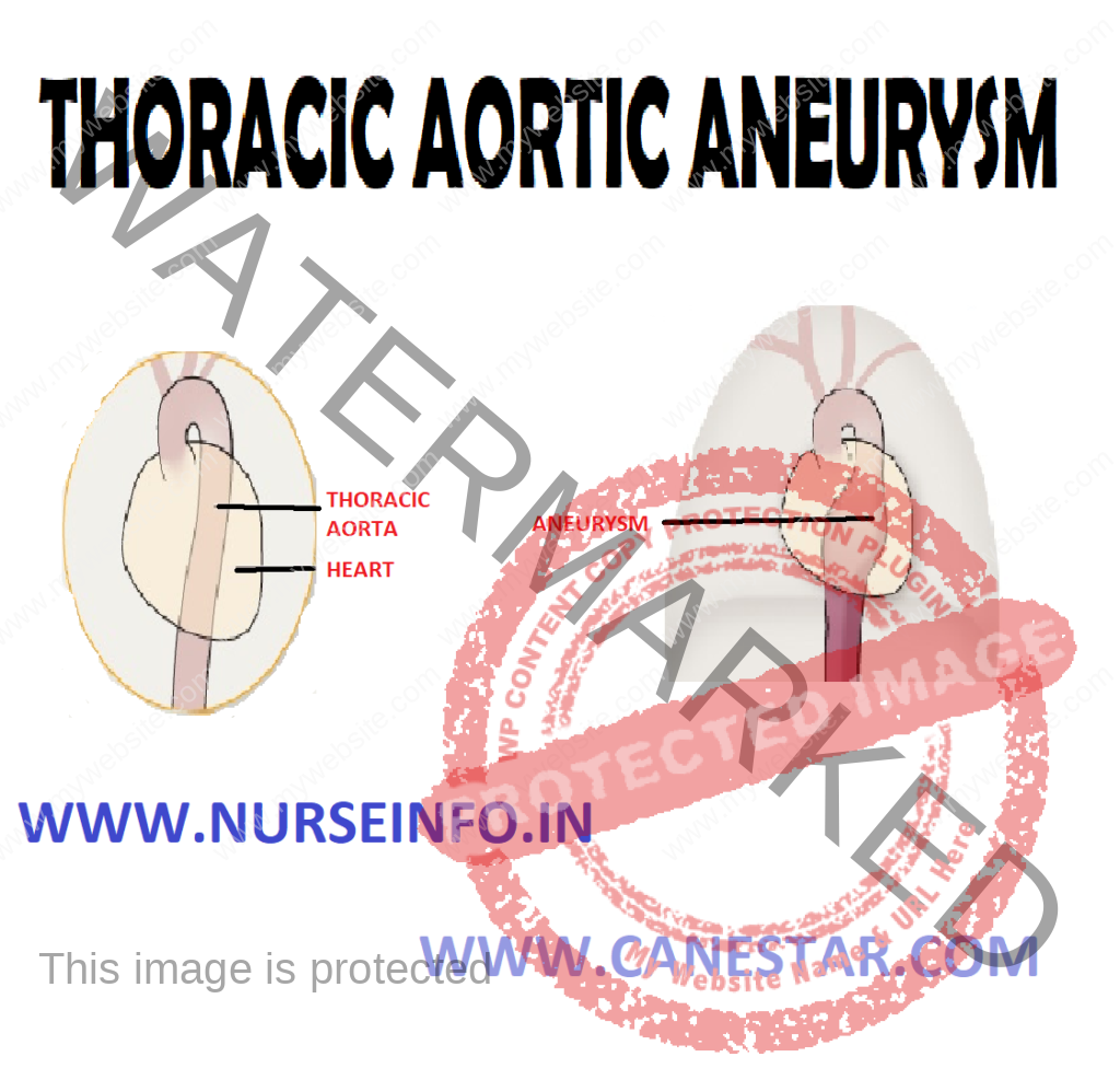 THORACIC AORTIC ANEURYSM – Introduction, Clinical Manifestations, Signs and Symptoms, Diagnostic Evaluation and Management 