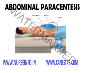 ABDOMINAL PARACENTESIS - Nurse Info