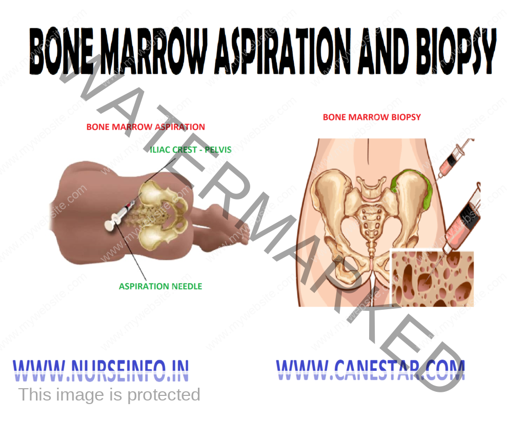 BONE MARROW BIOPSY AND ASPIRATION – Purpose, Indications, Site and Position of the Patient, General Instructions, Preliminary Assessment, Preparation of the patient and Environment, Equipment, Procedure, Post-procedure care and Complications 