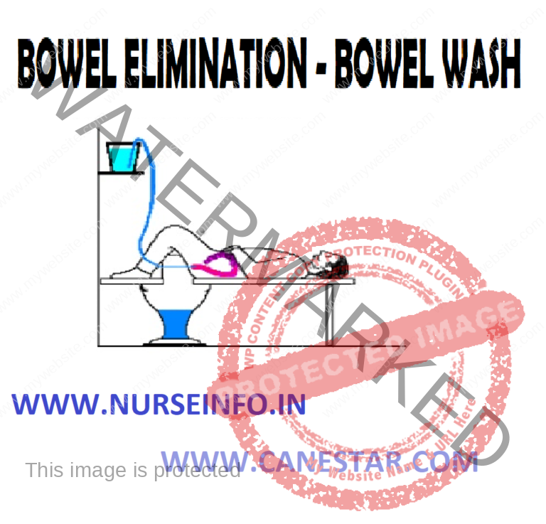 BOWEL WASH – Nurse Info BOWEL WASH – BOWEL ELIMINATION (Purpose ...