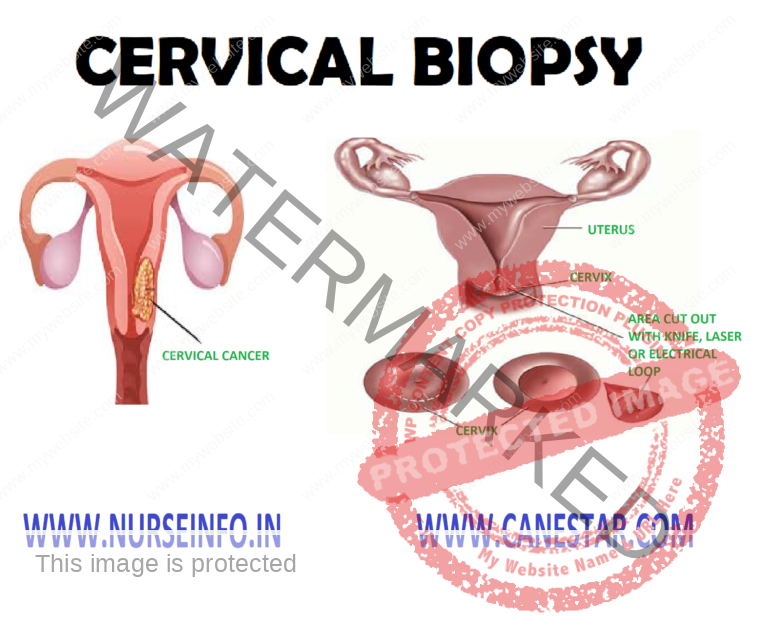 Cervical Biopsy Nurse Info