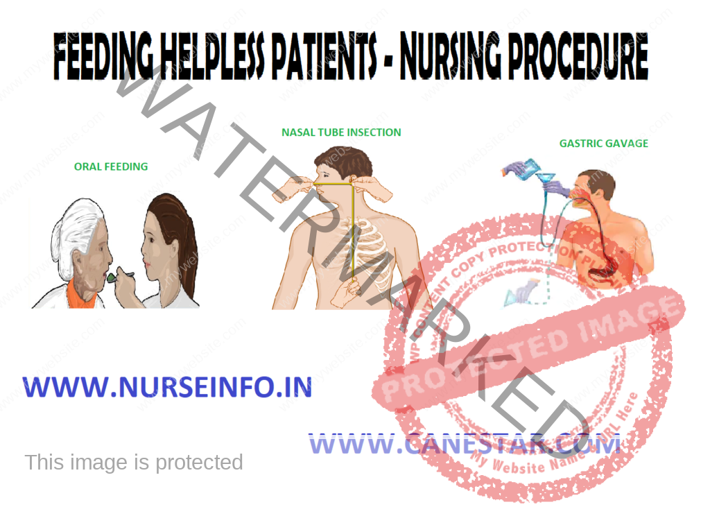 NURSING PROCEDURE - DIET FOR PATIENTS (Feeding the Helpless Patient, Nasogastric Tube Insertion, Gastric Gavage)  