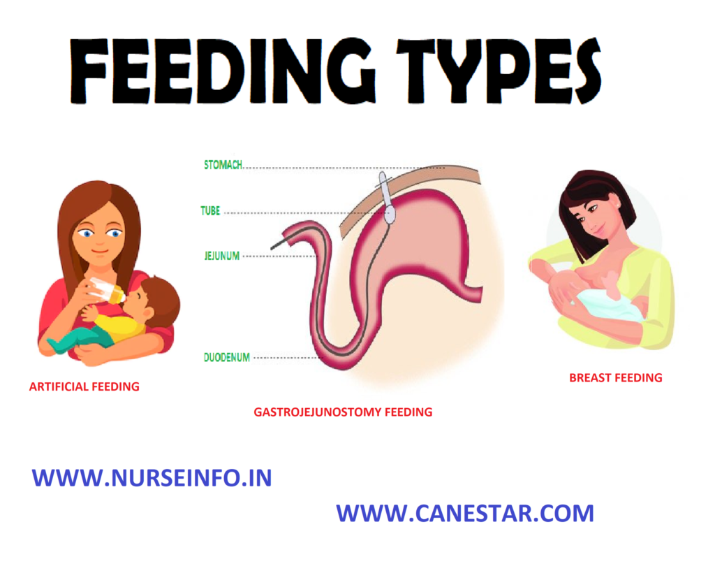 NURSING PROCEDURE - DIET FOR PATIENTS (Gastrojejunostomy Feeding, Breastfeeding and Artificial Feeding) 