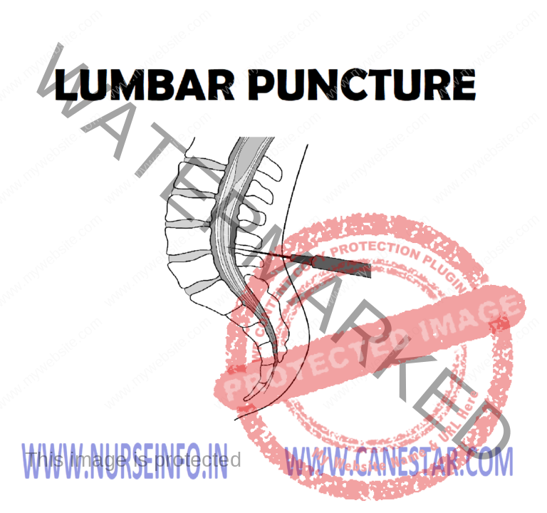 LUMBAR PUNCTURE Nurse Info