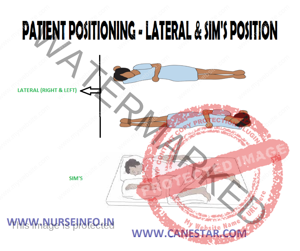  PATIENT POSITIONING –  LATERAL & SIM'S POSITION - Purpose, Principles, Factors Involved, Types, General Instructions, Preliminary Assessment, Equipment and Procedure 