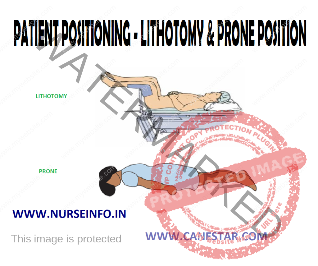 PATIENT POSITIONING – LITHOTOMY & PRONE POSITION - Purpose, Principles, Factors Involved, Types, General Instructions, Preliminary Assessment, Equipment and Procedure 