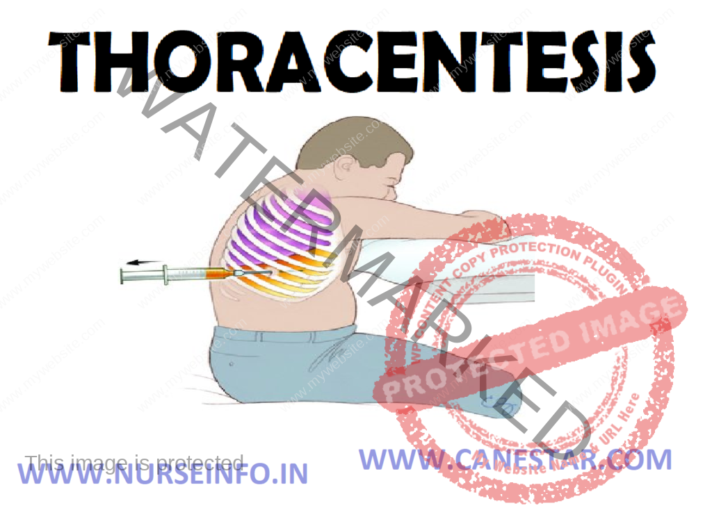 THORACENTESIS – Definition, Purpose, General Instructions, Preliminary Assessment, preparation of the Patient and Environment, Equipment, Procedure, After Care and Complications 