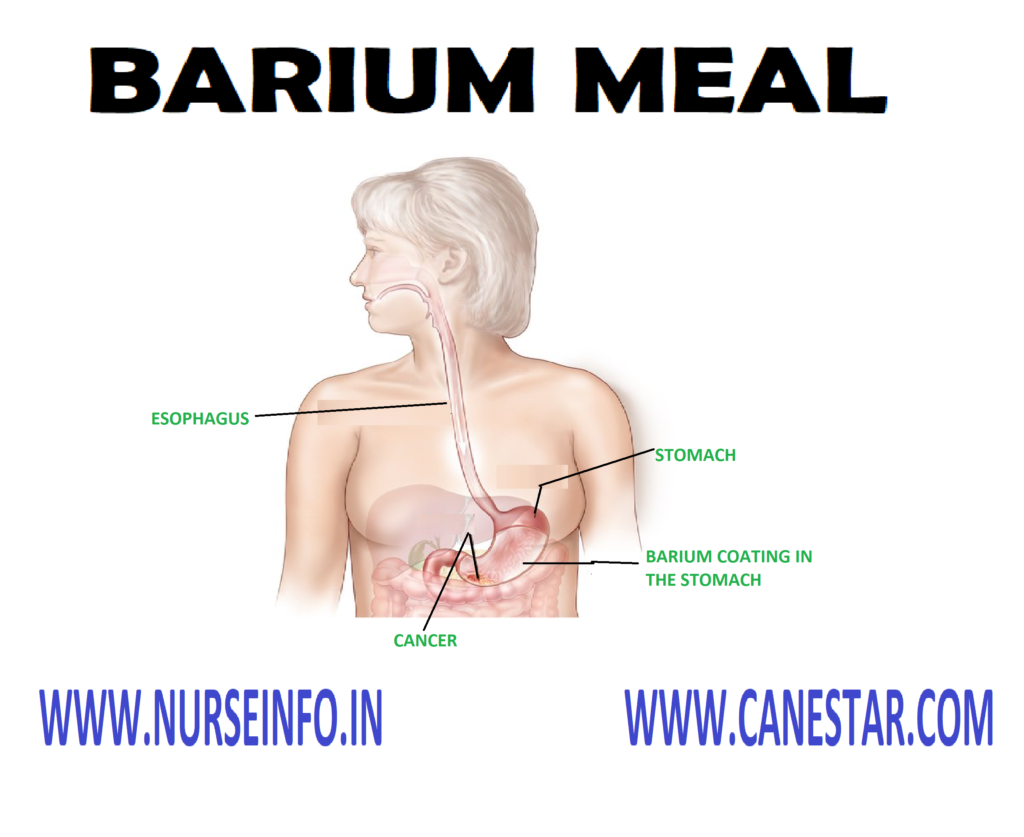 BARIUM MEAL – Purpose, Principles, General Instruction, Types, Preliminary Assessment, Preparation of the Articles, Preparation of the Patient, Procedure, After Care and Complication