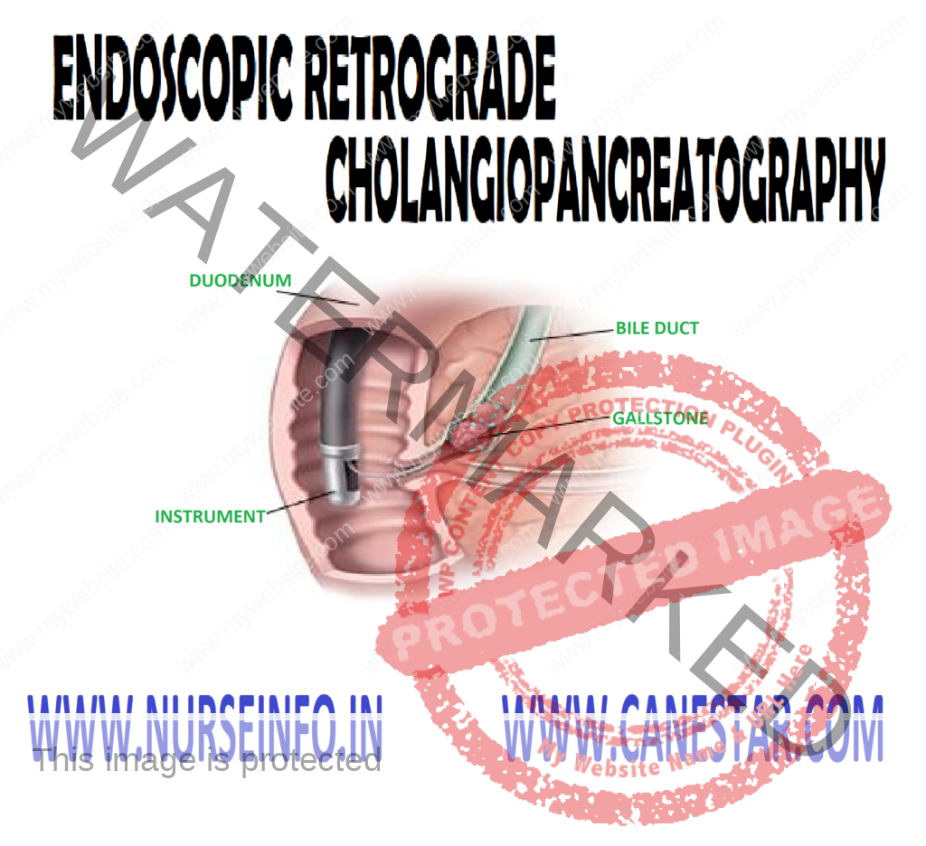 ENDOSCOPIC RETROGRADE CHOLANGIOPANCREATOGRAPHY – Purpose, Indications, Client Preparation, Procedure, Post-Procedural Care, Factor Affecting Diagnostic Results and Client Teaching 