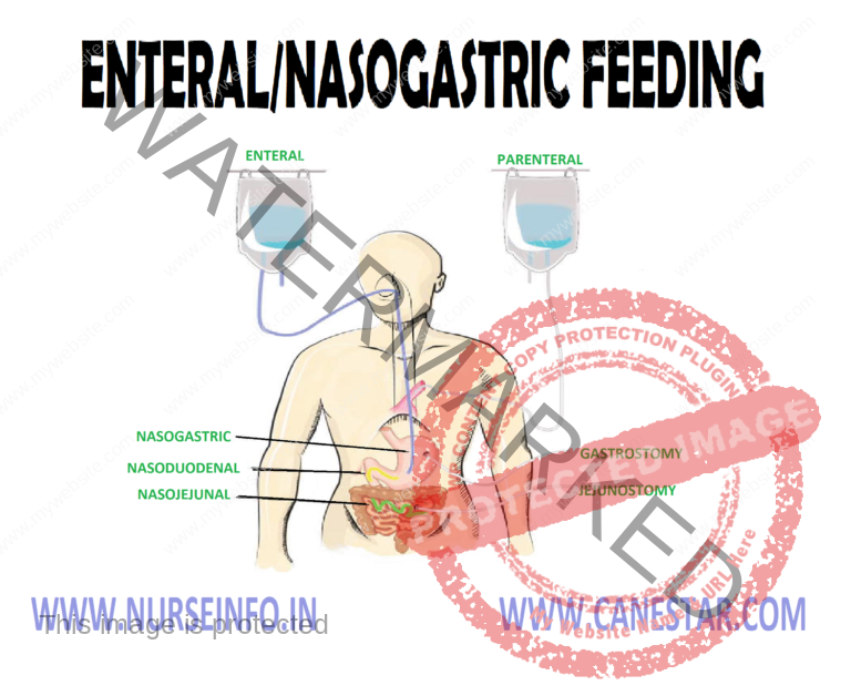 enteral-nasogastric-feeding-nurse-info