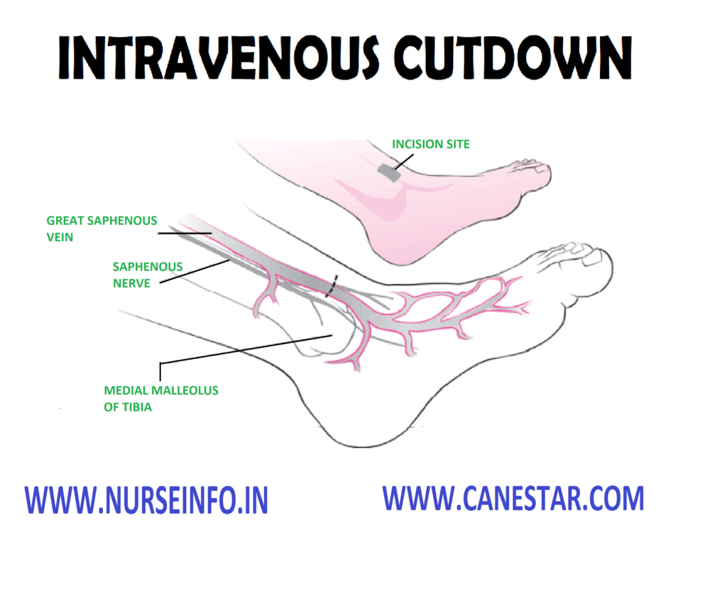 INTRAVENOUS CUT DOWN – Purpose, Principle, Preliminary Assessment, Preparation of the Patient, Equipment, Procedure, After Care and Complication 