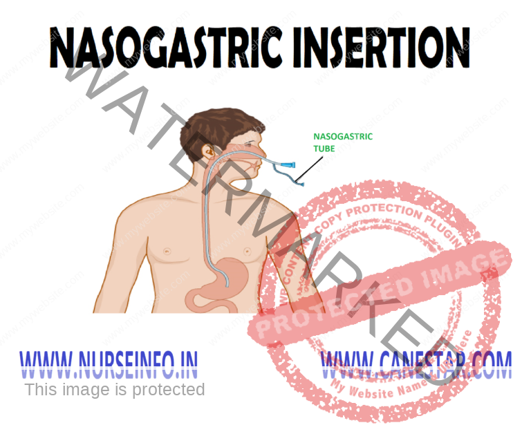 nasogastric-insertion-nurse-info