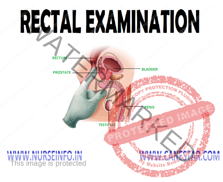 Rectal Examination Nurse Info