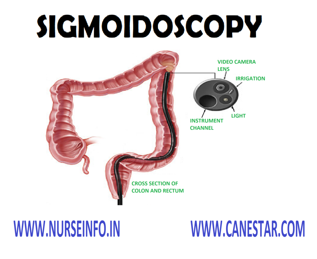 SIGMOIDOSCOPY – Definition, Purpose, Principle, General Instruction, Preliminary Assessment, Preparation of the Article, Preparation of the Patient, Procedure and After Care 