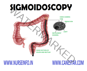 SIGMOIDOSCOPY - Nurse Info