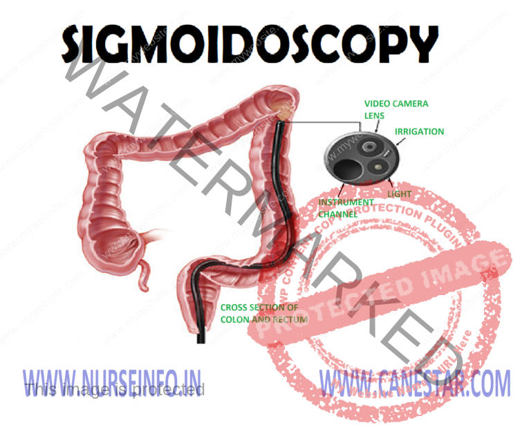 SIGMOIDOSCOPY - Nurse Info