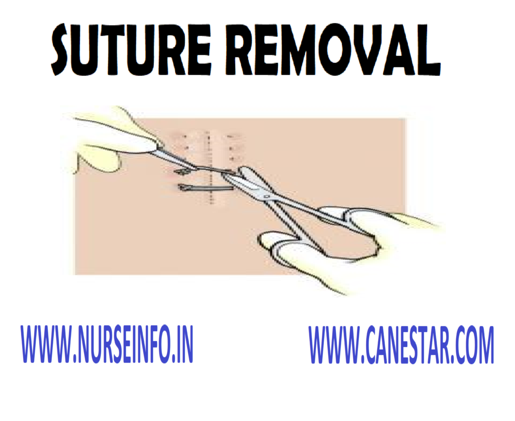 SUTURE REMOVAL – Purpose, Principle, Usual Timing, Factors Affecting, Types, General Instructions, Preliminary Assessment, Preparation of Patient and Environment, Procedure, Equipment and Post-Procedure Care