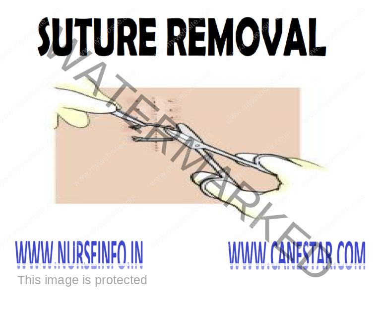 SUTURE REMOVAL Nurse Info