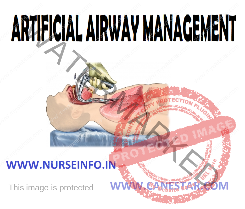 ARTIFICIAL AIRWAY MANAGEMENT – Definition, Indications, Endotracheal Route of Insertion, Tube Types, General Instructions, Equipment, Preparation of the Patient and the Environment, Procedure, After Care and Complications