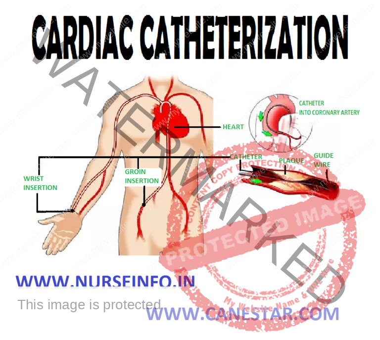 CARDIAC CATHETERIZATION Nurse Info