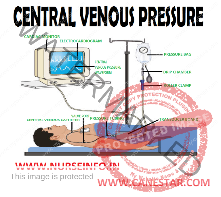 central-venous-pressure-nurse-info