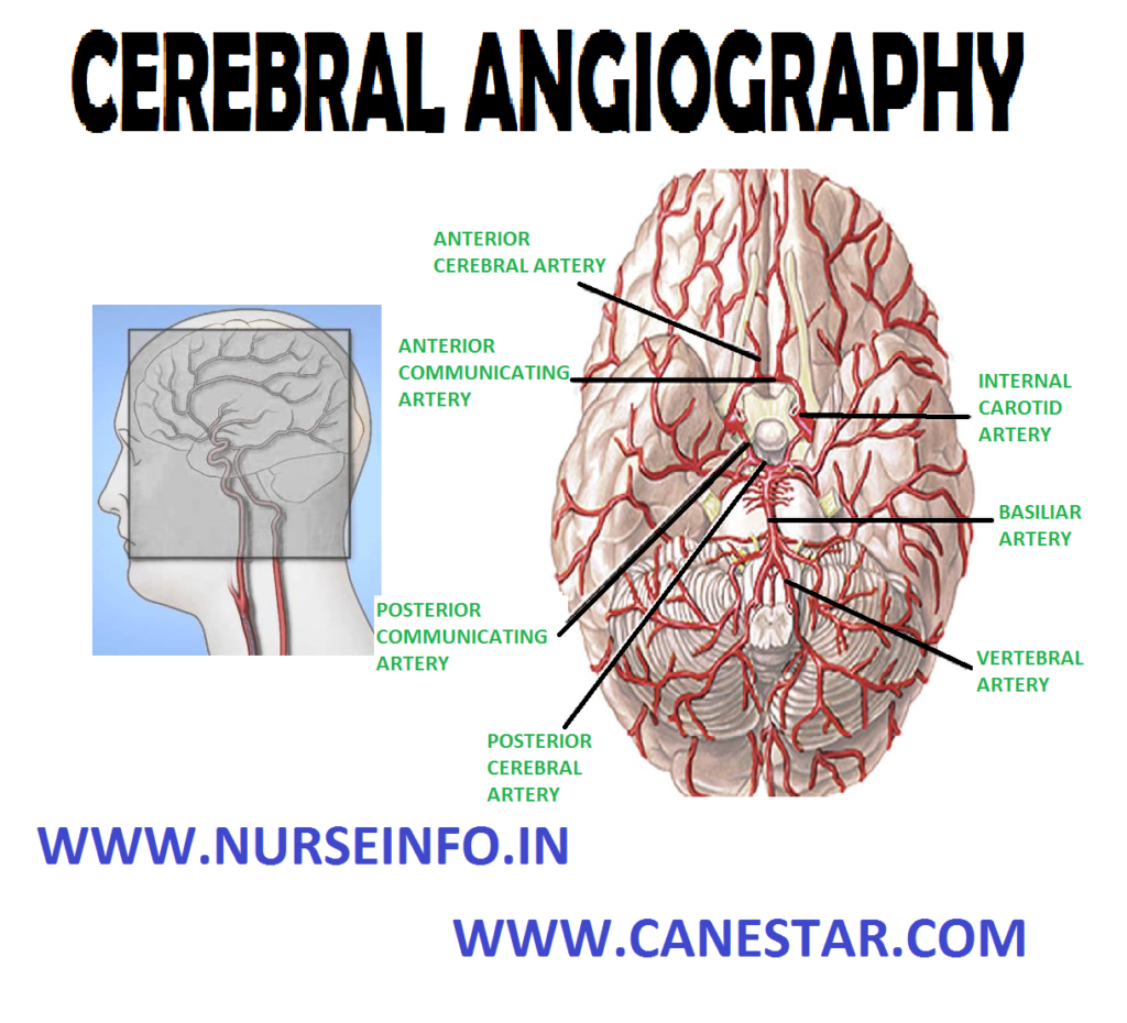 CEREBRAL ANGIOGRAPHY – Definition, Purpose, General Instructions, Client Preparation, Procedure, After Care and Complications