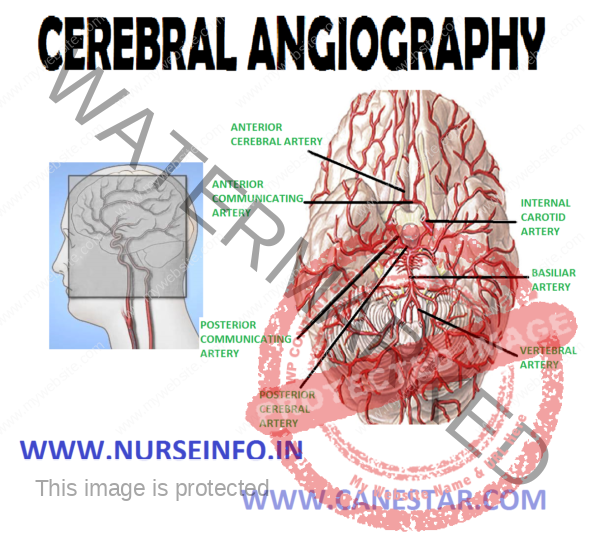 CEREBRAL ANGIOGRAPHY Nurse Info