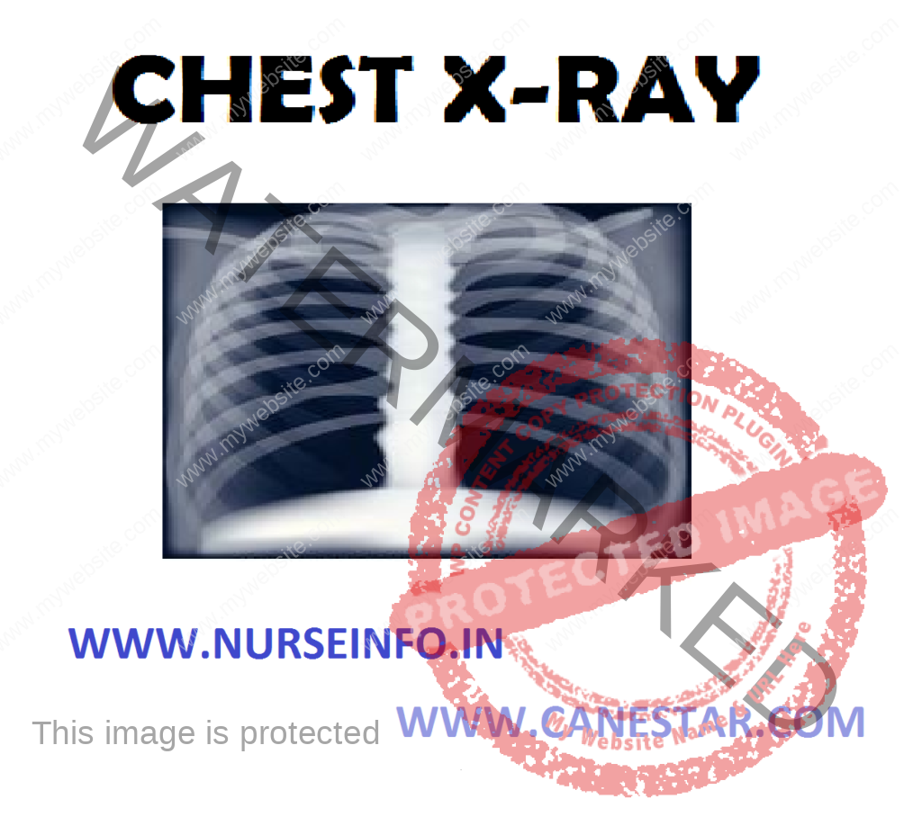 CHEST X-RAY (Purpose, Indications, Normal Findings, Standard Positions Used, Portable Chest X-ray, Lateral View, Lateral Decubitus Position, Oblique Position, Lordotic Position and Nursing Considerations) 