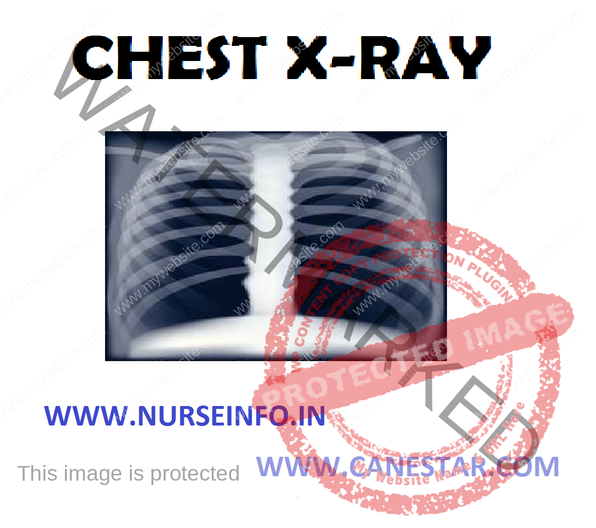 Chest X Ray Nurse Info