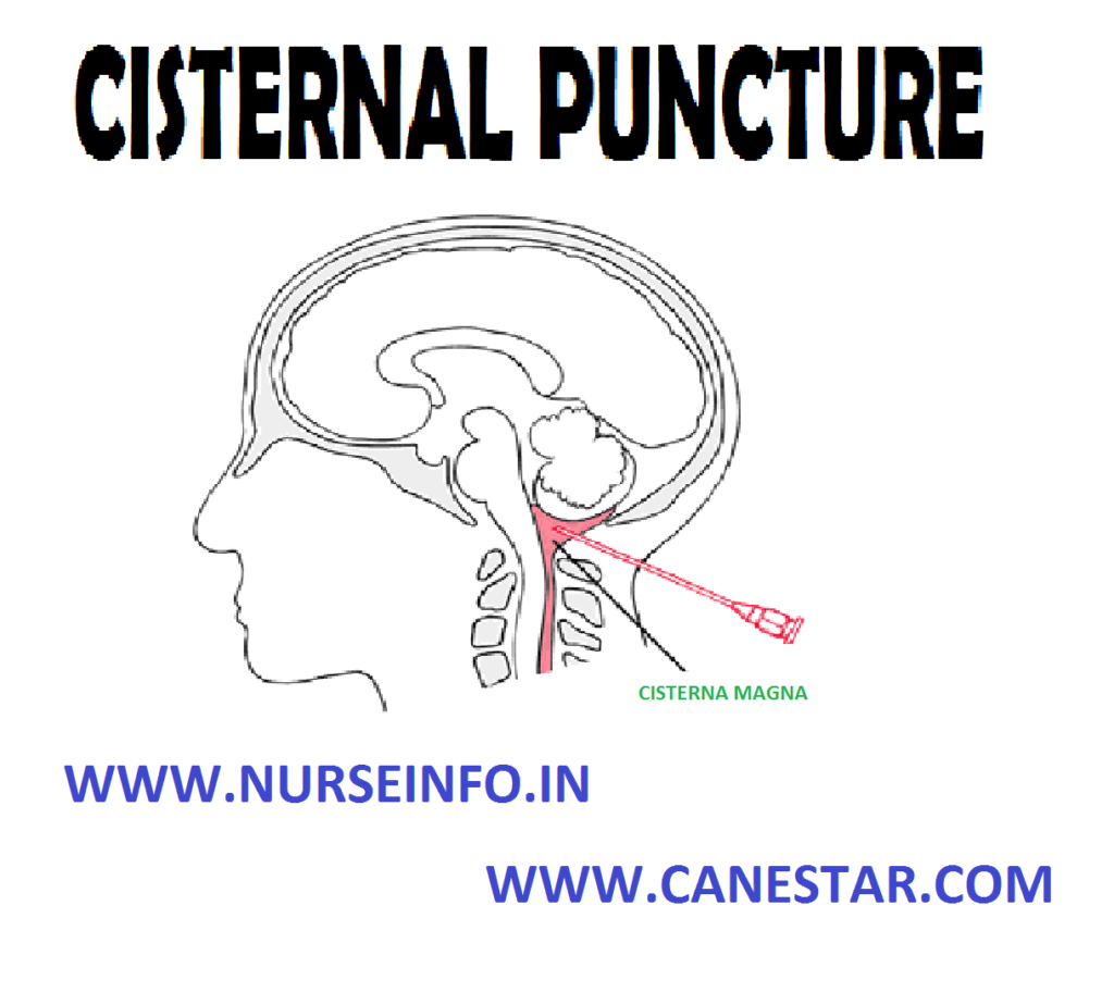 CISTERNAL PUNCTURE – Definition, Purpose, Client Preparation, Procedure and After Care