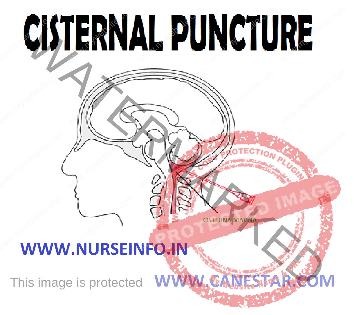 cisternal-puncture-nurse-info