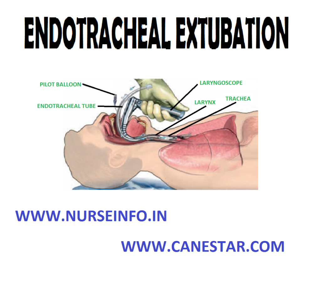 ENDOTRACHEAL EXTUBATION – Objective, Assessment Phase, Precautions, Planning Phase, Client/Family Teaching and Implementation Phase)