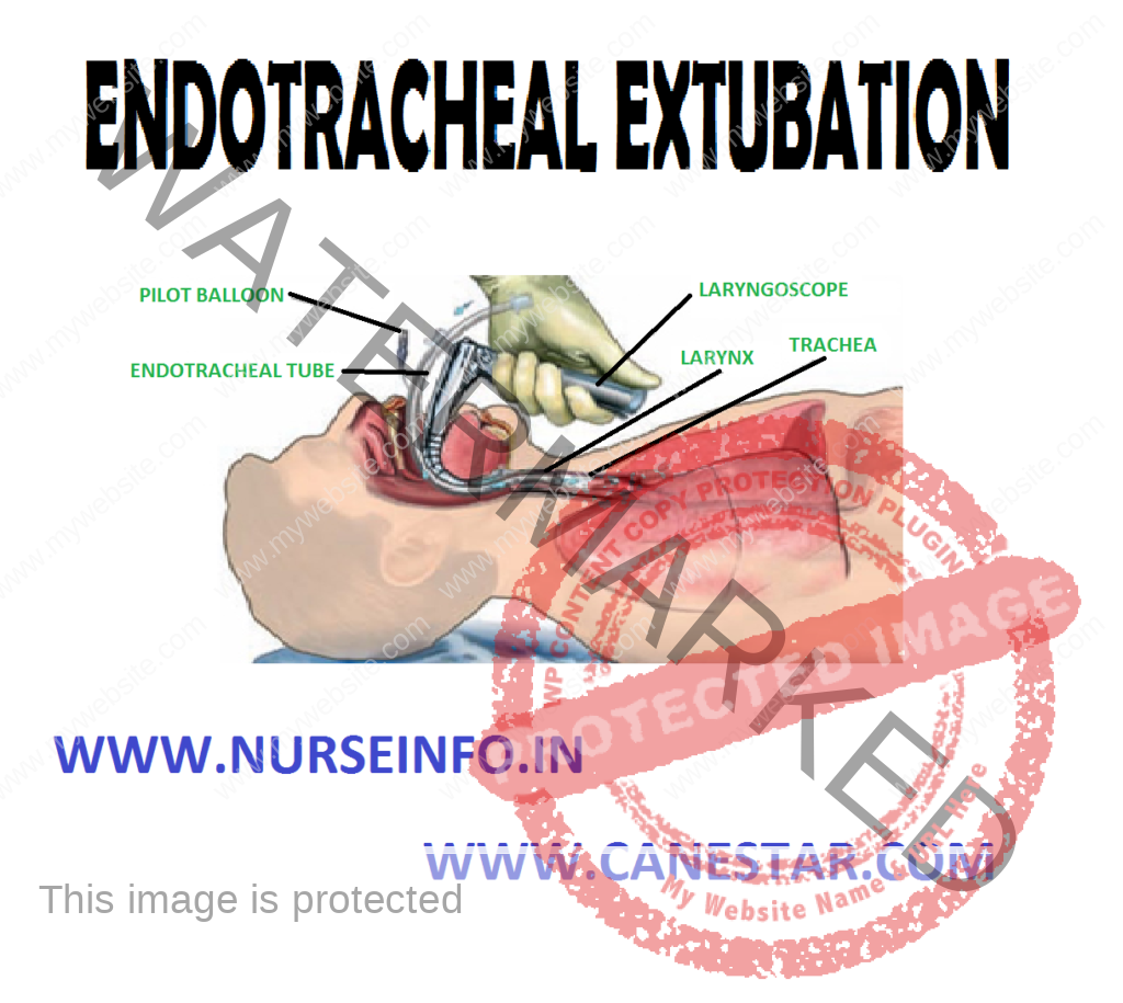 ENDOTRACHEAL EXTUBATION – Objective, Assessment Phase, Precautions, Planning Phase, Client/Family Teaching and Implementation Phase) 