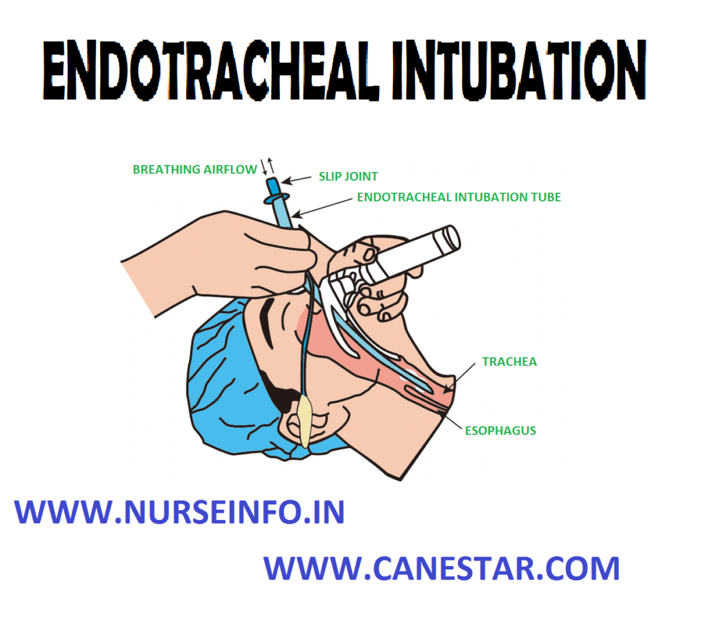 ENDOTRACHEAL INTUBATION – Definition, Purpose, Assessment Phase, Precautions, Planning Phase, Client/Family Teaching and Equipment Used