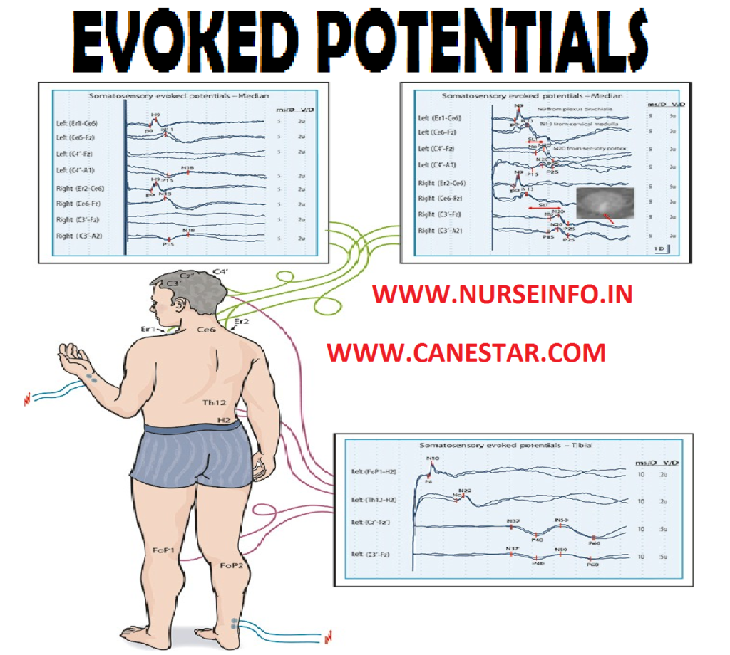 EVOKED POTENTIALS – Definition, Purpose, Indication, Types of Evoked Potentials, Advantages, Client Preparation, Procedure and After Care 