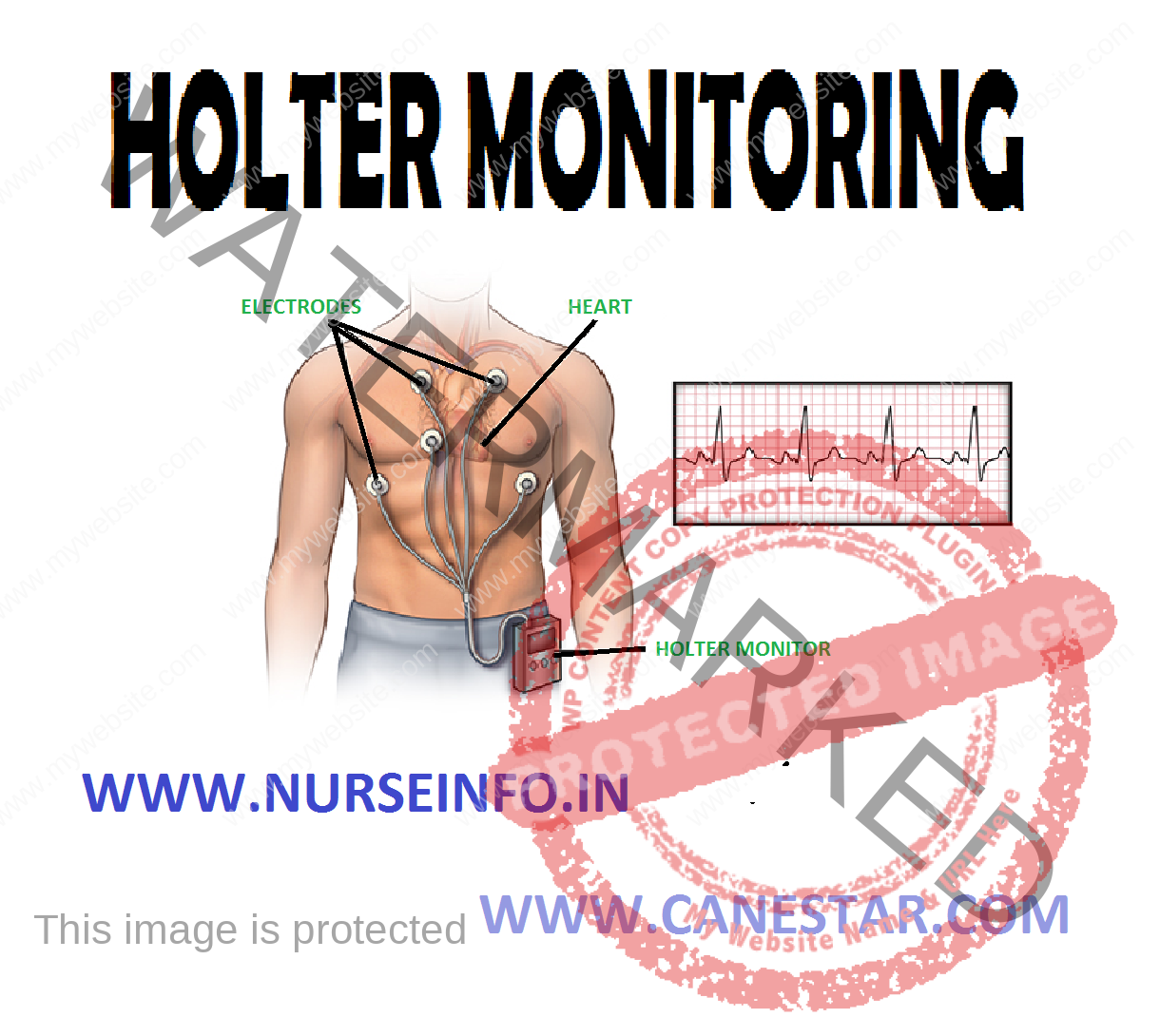 HOLTER MONITORING Nurse Info