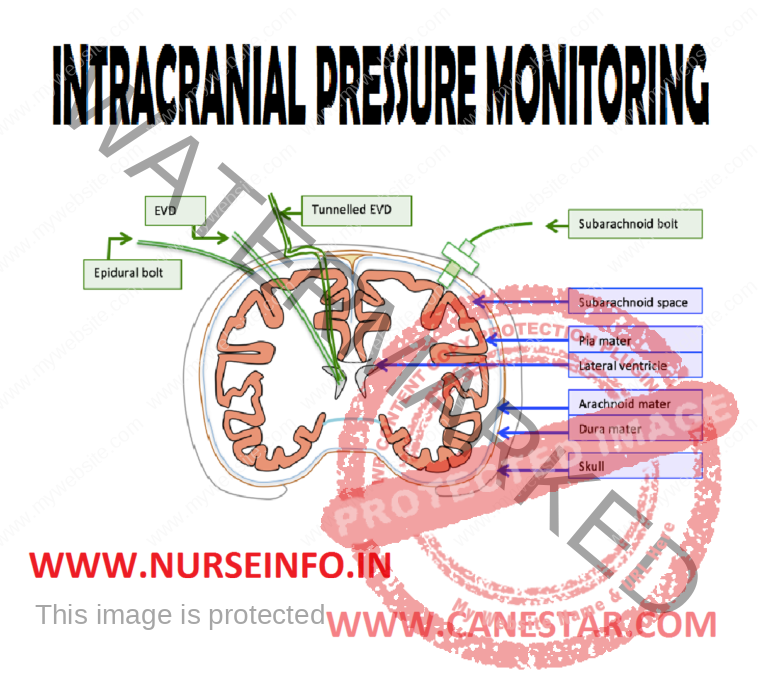 INTRACRANIAL PRESSURE MONITORING - Nurse Info