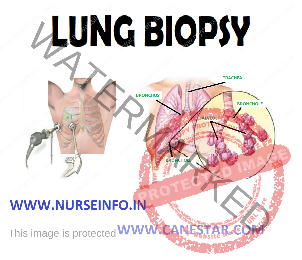 LUNG BIOPSY Nurse Info