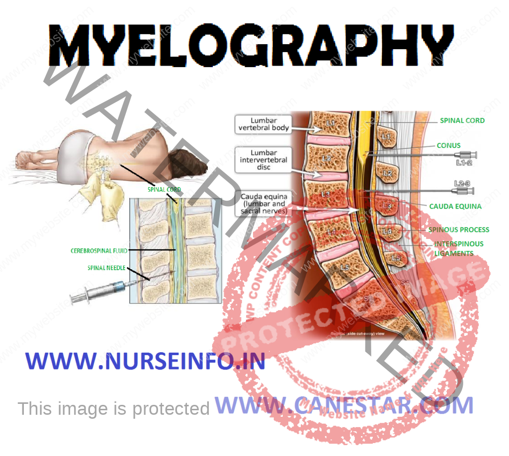 MYELOGRAPHY – Definition, Purpose, Indications, General Instructions, Client Preparation, Procedure and After Care 