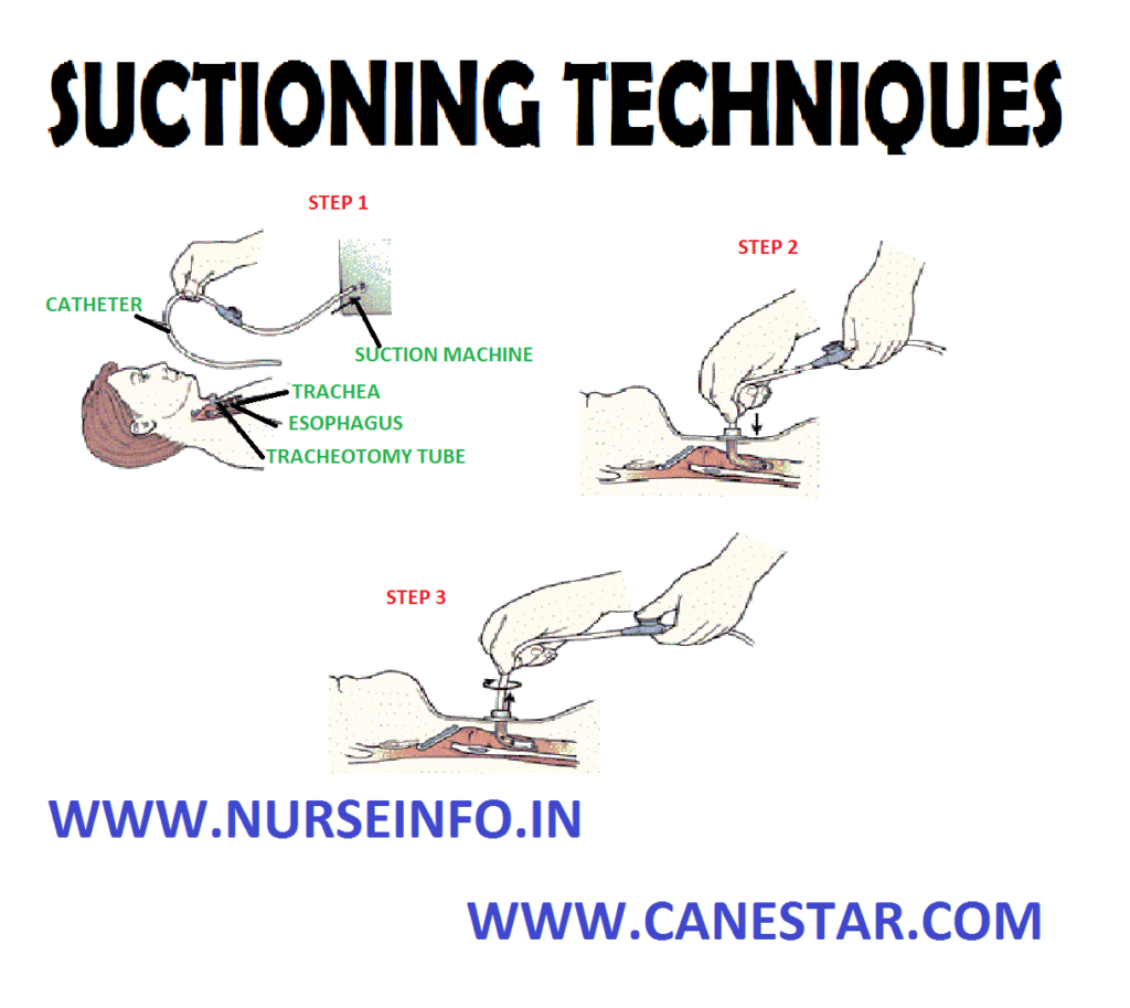 SUCTIONING TECHNIQUE – Types, Orotracheal and Nasotracheal and Tracheal Suctioning