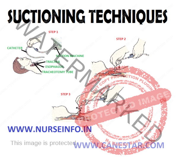 Suctioning Technique Nurse Info 1015