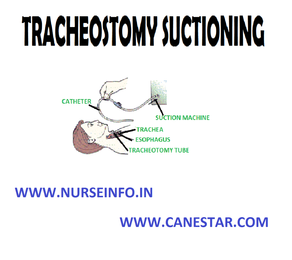 TRACHEOSTOMY SUCTIONING – Definition, Purpose, Equipment, Preliminary Assessment and Procedure