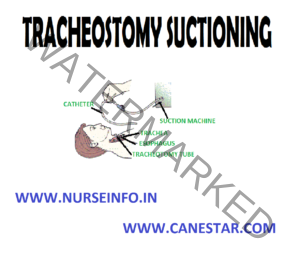 TRACHEOSTOMY SUCTIONING - Nurse Info