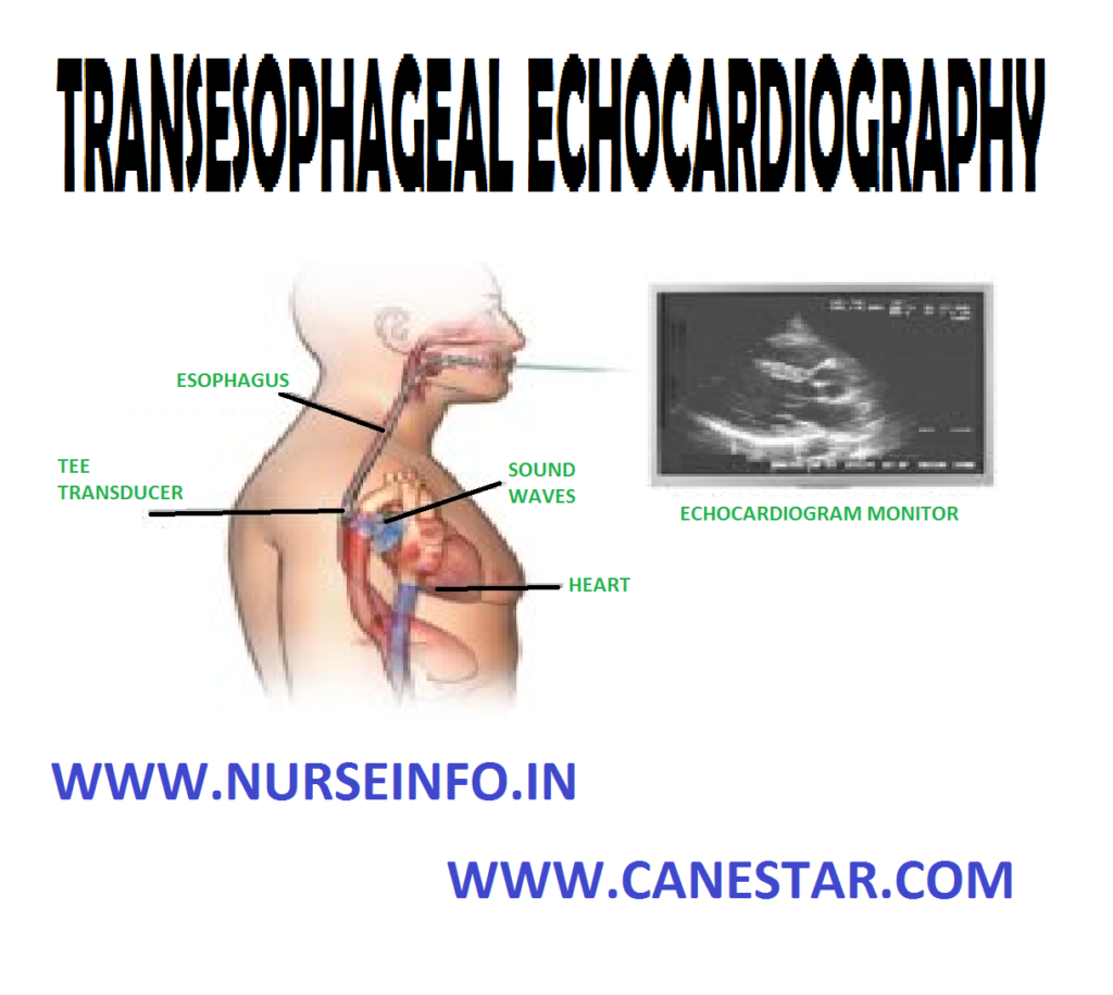 TRANSESOPHAGEAL ECHOCARDIOGRAPHY – Definition, Purpose, Equipment, Pre-TTE Care, During Procedure and Post-TEE Care (NURSING PROCEDURE) 