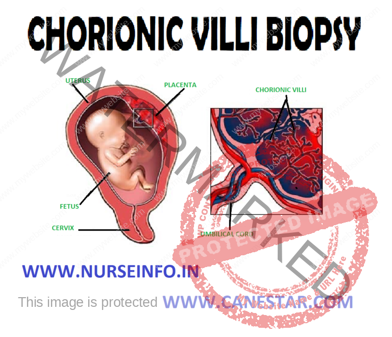 CHORIONIC VILLI BIOPSY Nurse Info