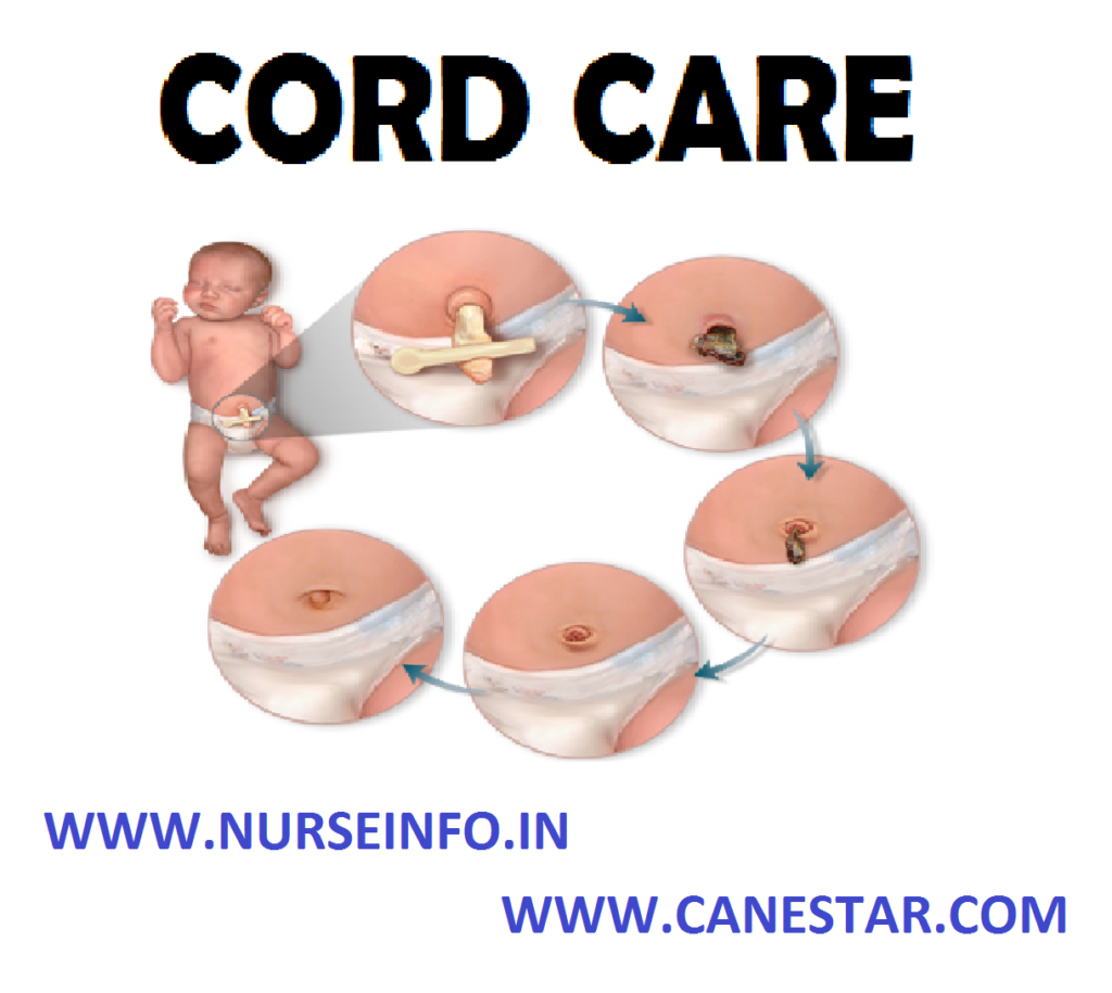 CORD CARE – Purpose, General Instruction, Equipment Needed, Procedure and After Care (COMMUNITY HEALTH NURSING) 