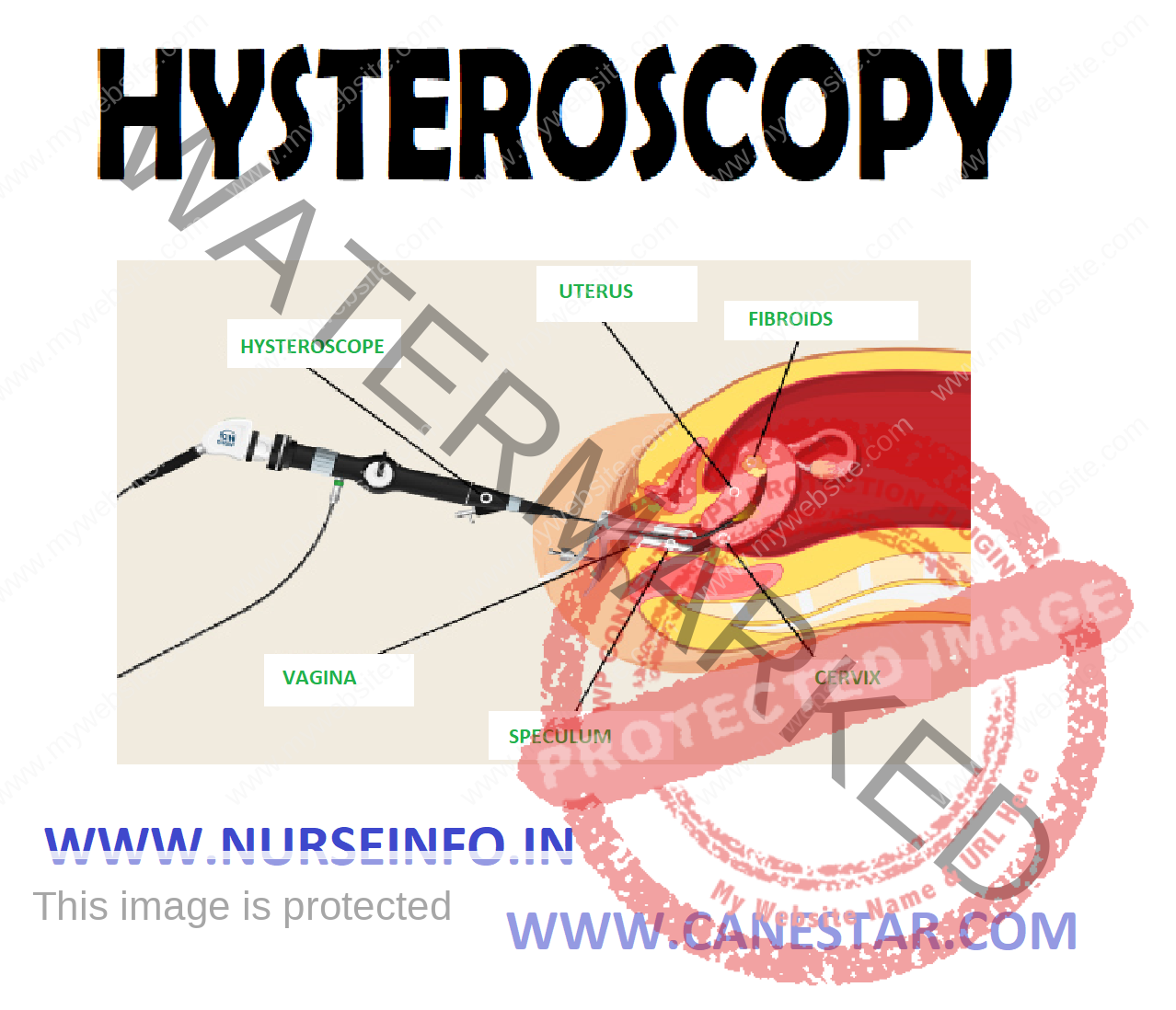 HYSTEROSCOPY Nurse Info