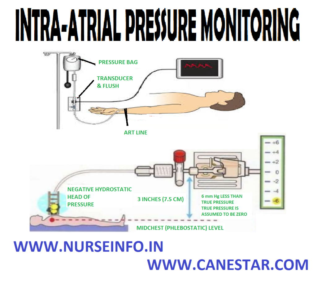 INTRA-ATRIAL PRESSURE MONITORING – Definition, Formula, Purpose, Indication, Components, Special Considerations, Client and Equipment Preparation, Equipment Needed, For Blood Sample Collection, Procedure, After Care and Complication (NURSING PROCEDURE)